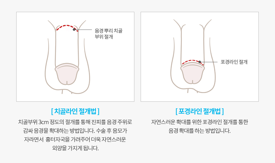 요로결석,신장, 요관, 방광에 생기는 돌
치료가 필요합니다.